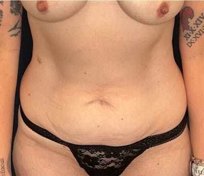 BodyTite by Dr. Booth Before & After Gallery - Patient 419239 - Image 1