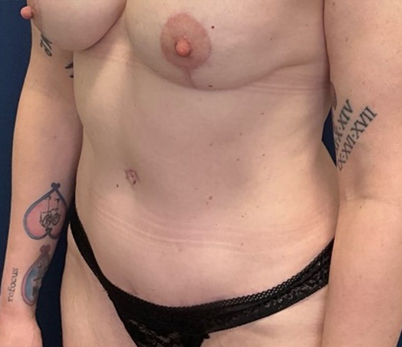BodyTite by Dr. Booth Before & After Gallery - Patient 419239 - Image 4