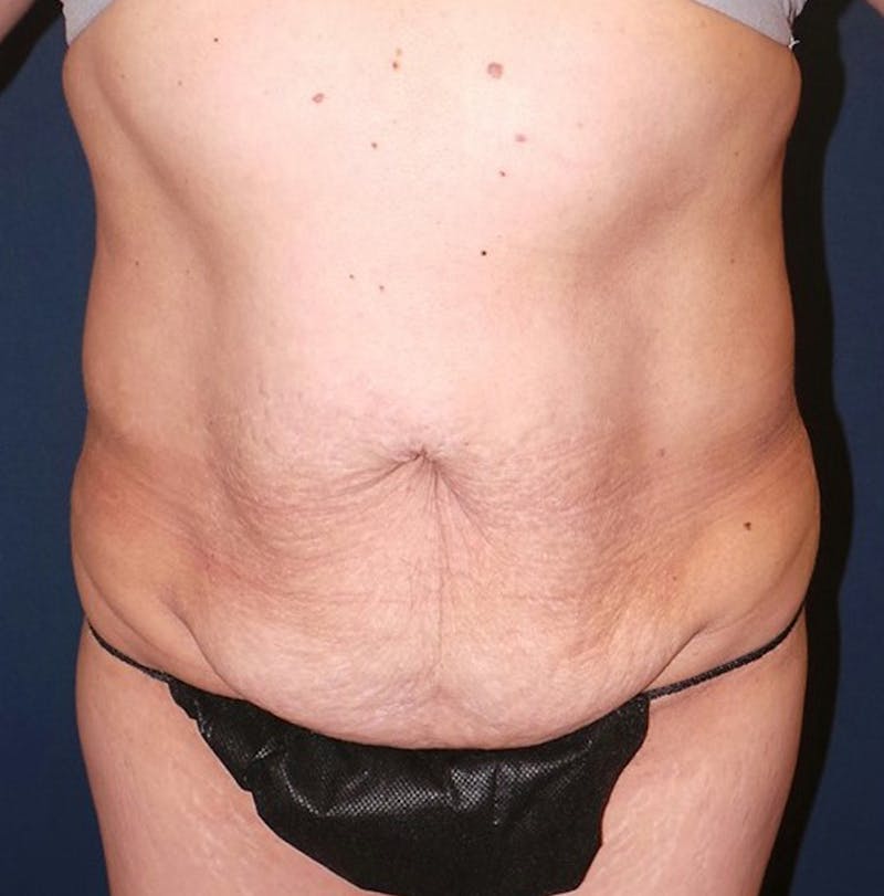 Lipo 360 by Dr. Booth Before & After Gallery - Patient 132628 - Image 1