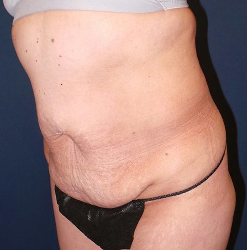 Lipo 360 by Dr. Booth Before & After Gallery - Patient 132628 - Image 3