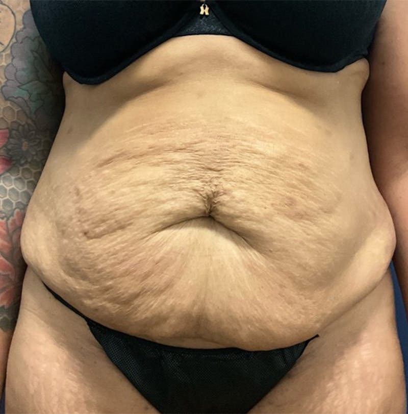Lipo 360 by Dr. Booth Before & After Gallery - Patient 222583 - Image 1