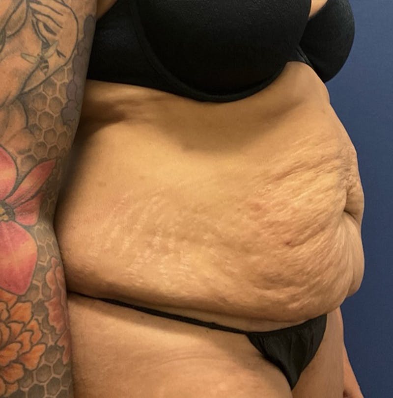 Lipo 360 by Dr. Booth Before & After Gallery - Patient 222583 - Image 3