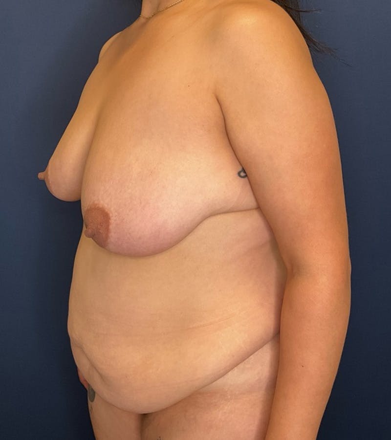 Mommy Makeover by Dr. Booth Before & After Gallery - Patient 424919 - Image 7