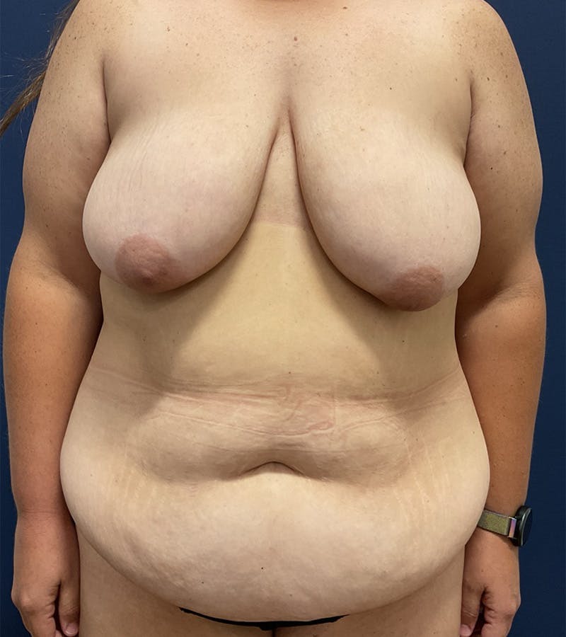 Mommy Makeover by Dr. Booth Before & After Gallery - Patient 338235 - Image 1