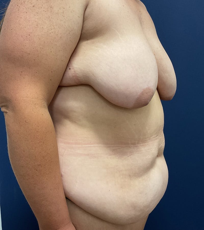 Mommy Makeover by Dr. Booth Before & After Gallery - Patient 338235 - Image 3