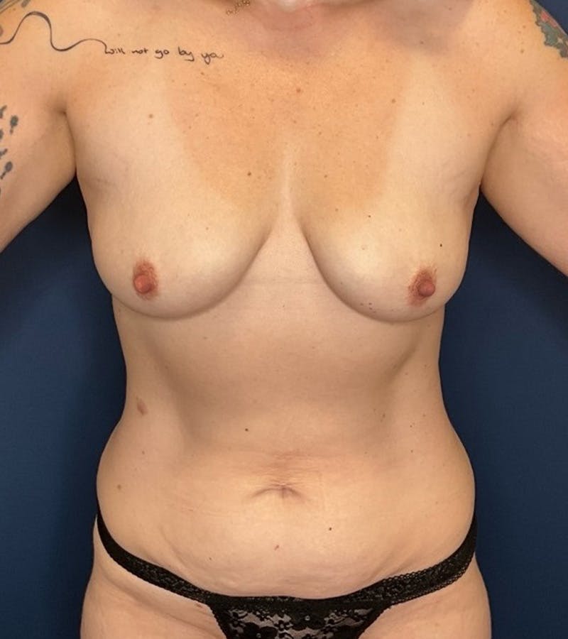 Mommy Makeover by Dr. Booth Before & After Gallery - Patient 368422 - Image 1