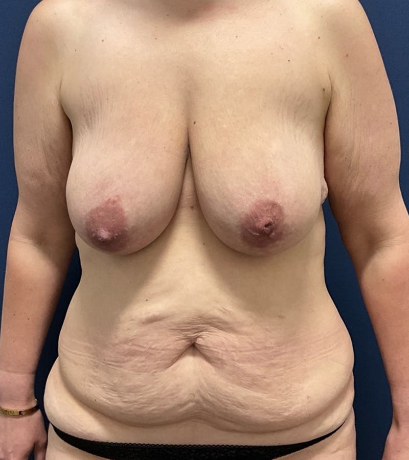 Mommy Makeover by Dr. Booth Before & After Gallery - Patient 312589 - Image 3