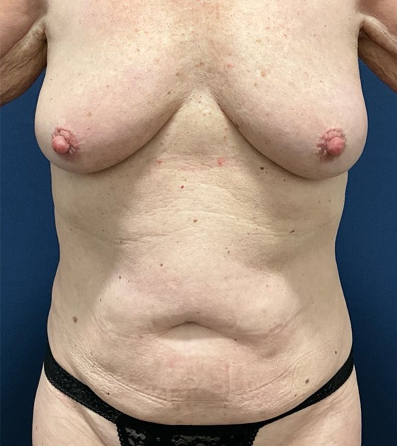 Mommy Makeover by Dr. Booth Before & After Gallery - Patient 198693 - Image 1