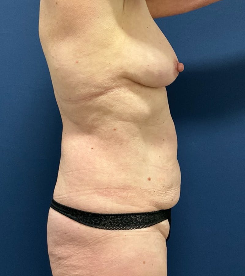 Mommy Makeover by Dr. Booth Before & After Gallery - Patient 198693 - Image 7