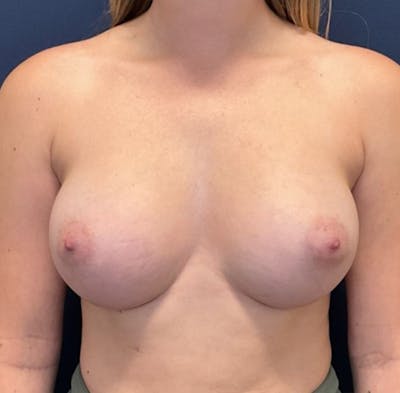 Breast Augmentation by Dr. Booth Before & After Gallery - Patient 512635 - Image 2