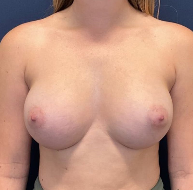 Breast Augmentation by Dr. Booth Before & After Gallery - Patient 512635 - Image 2