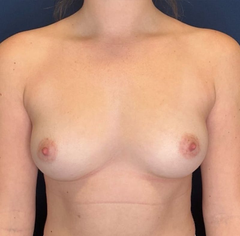Breast Augmentation by Dr. Booth Before & After Gallery - Patient 512635 - Image 1