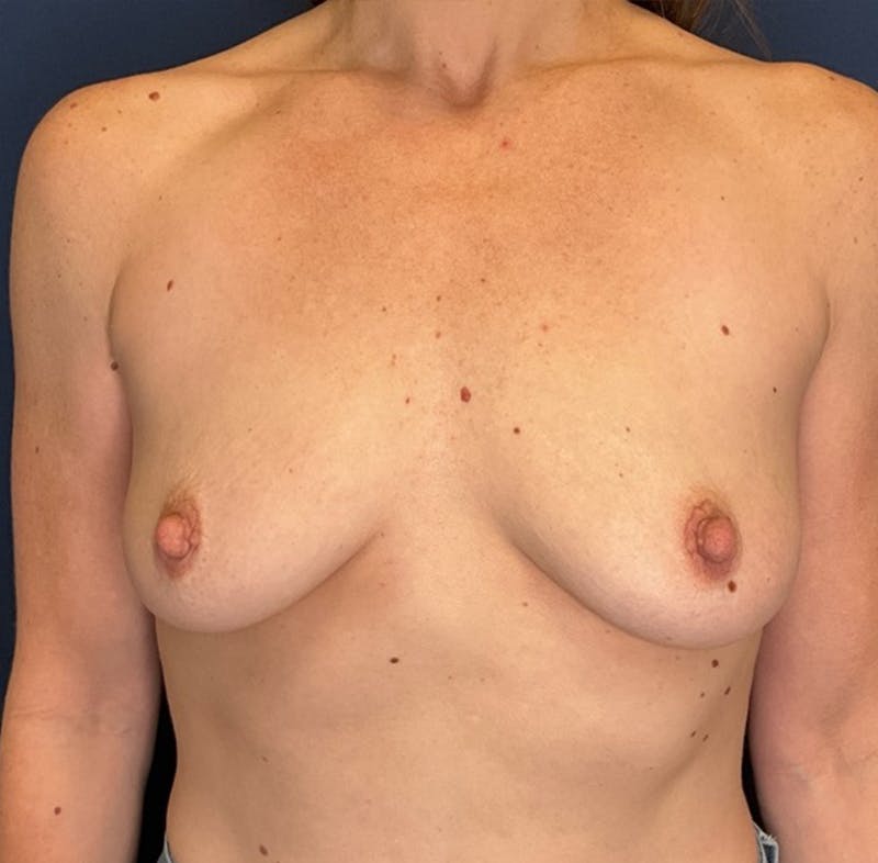 Breast Augmentation by Dr. Booth Before & After Gallery - Patient 327374 - Image 1