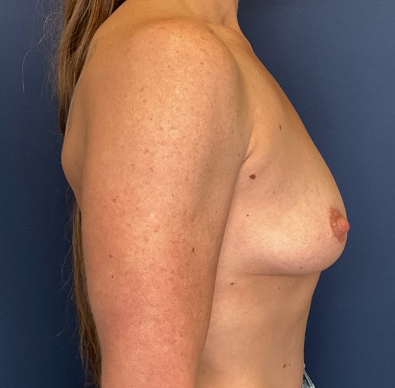 Breast Augmentation by Dr. Booth Before & After Gallery - Patient 327374 - Image 7