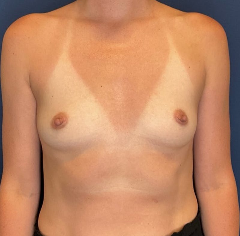 Breast Augmentation by Dr. Booth Before & After Gallery - Patient 401137 - Image 1
