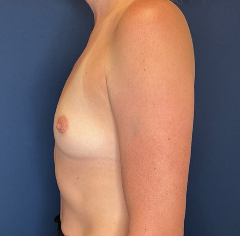 Breast Augmentation by Dr. Booth Before & After Gallery - Patient 401137 - Image 7
