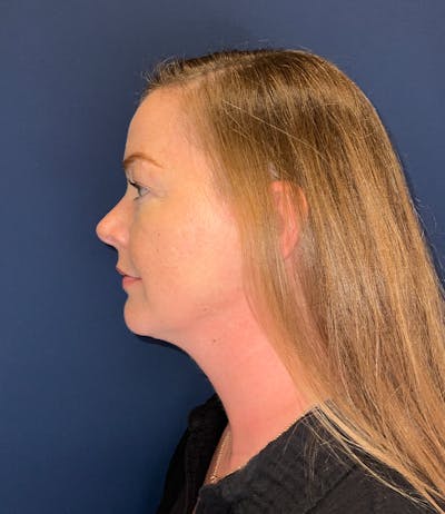 Chin Augmentation by Dr. Booth Before & After Gallery - Patient 124625 - Image 2