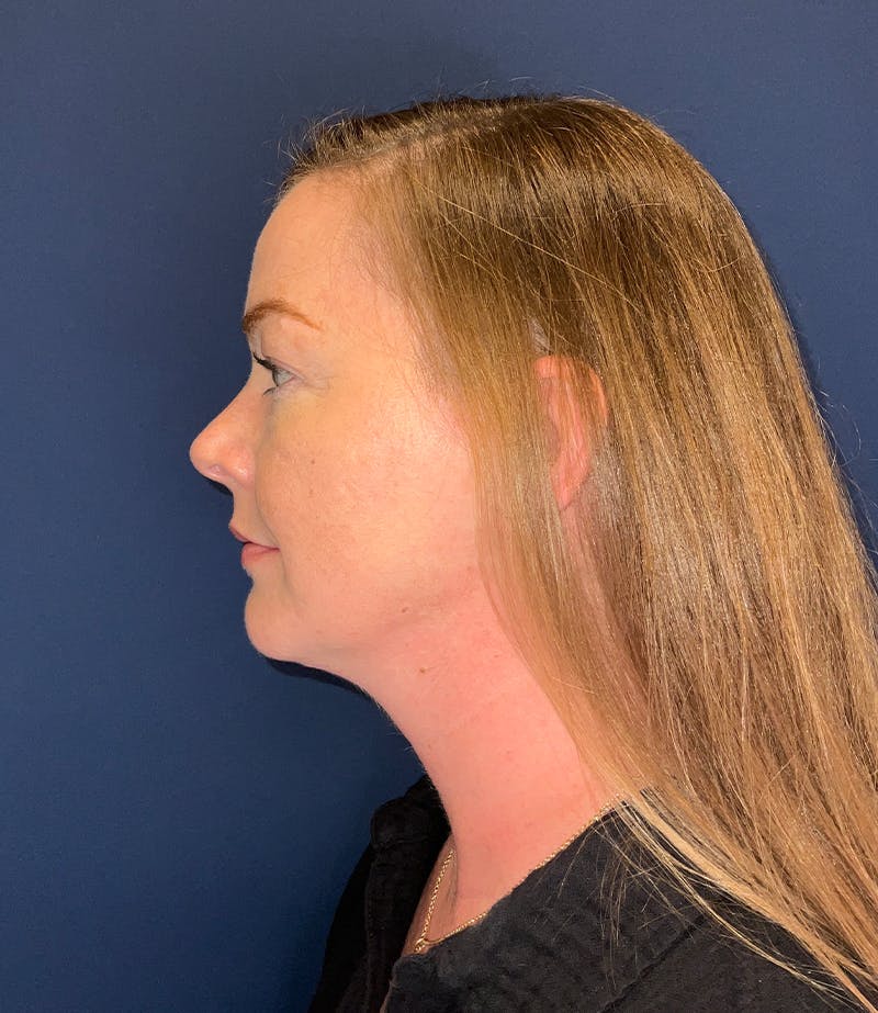 Chin Augmentation by Dr. Booth Before & After Gallery - Patient 124625 - Image 2