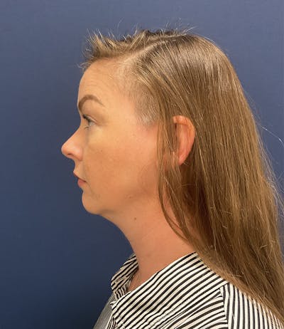 Chin Augmentation by Dr. Booth Before & After Gallery - Patient 124625 - Image 1