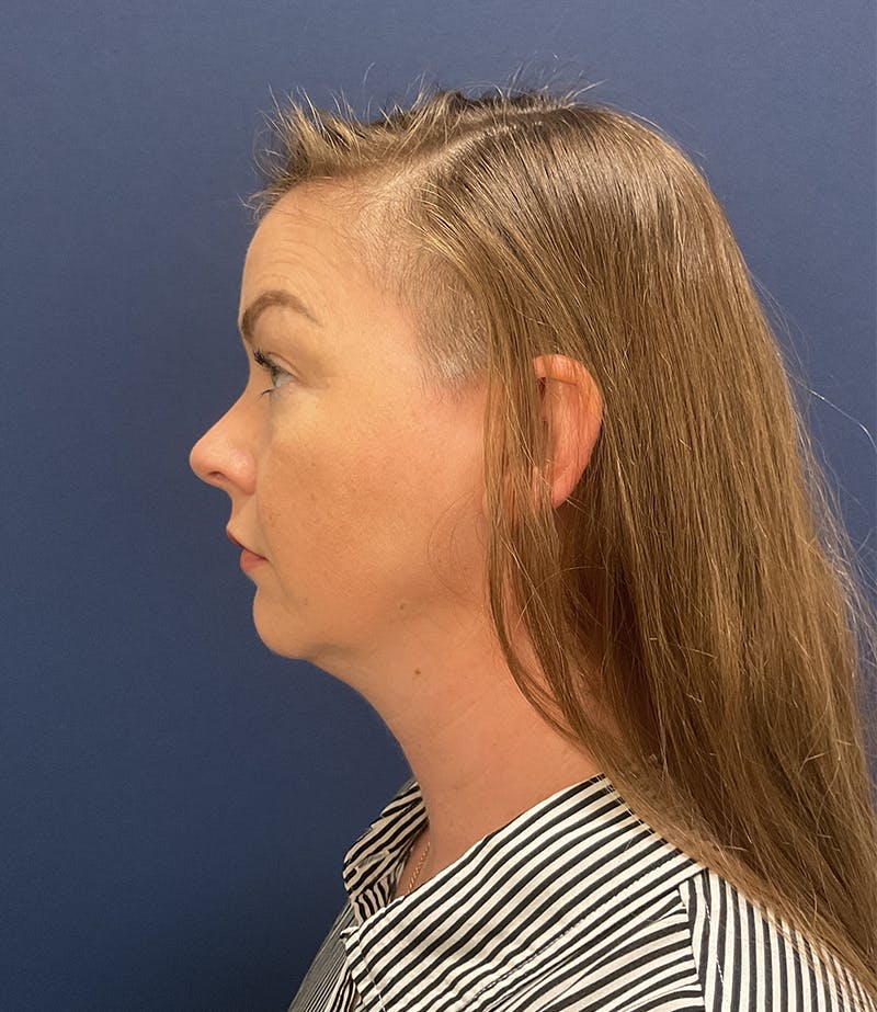 Chin Augmentation by Dr. Booth Before & After Gallery - Patient 124625 - Image 1