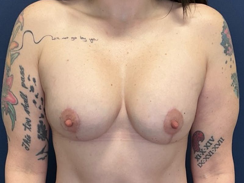  Breast Lift with Augmentation Dr. Booth Before & After Gallery - Patient 395520 - Image 2