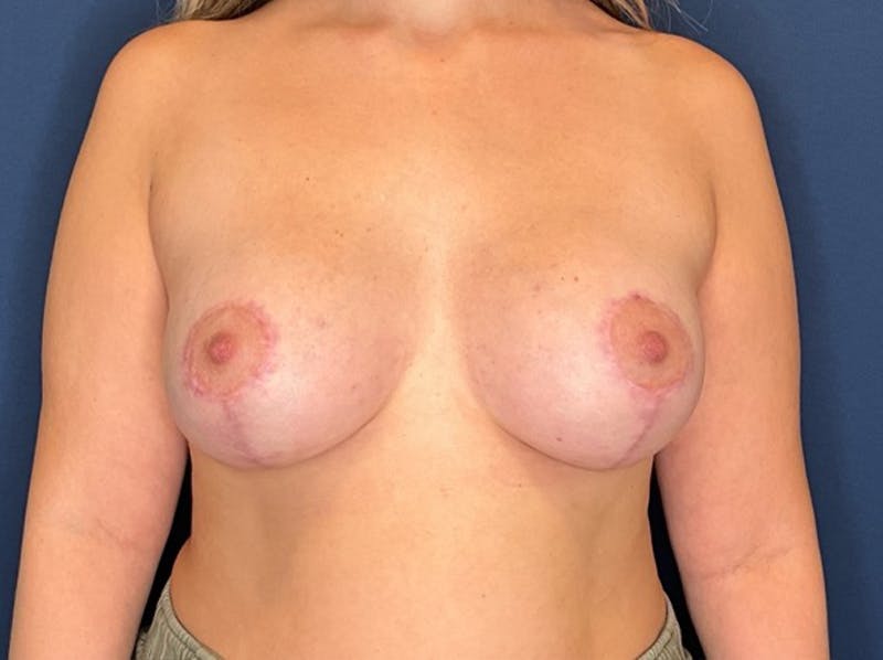  Breast Lift with Augmentation Dr. Booth Before & After Gallery - Patient 200094 - Image 2
