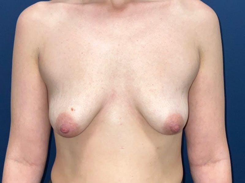  Breast Lift with Augmentation Dr. Booth Before & After Gallery - Patient 200094 - Image 1