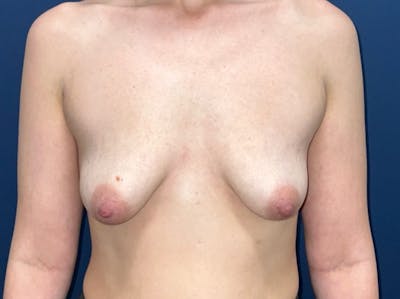 Breast Lift with Augmentation Dr. Booth Before & After Gallery - Patient 200094 - Image 1