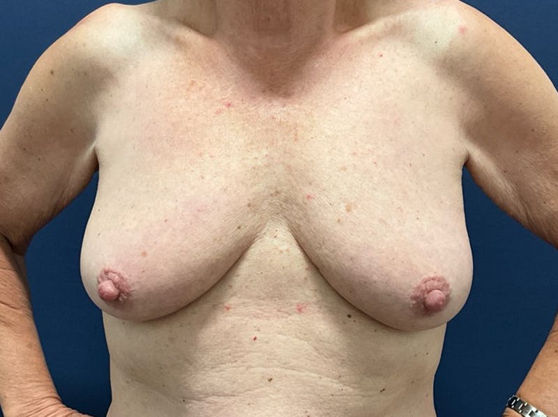  Breast Lift with Augmentation Dr. Booth Before & After Gallery - Patient 788194 - Image 1