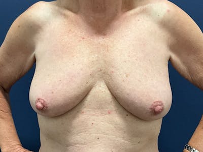 Breast Lift with Augmentation Dr. Booth Before & After Gallery - Patient 788194 - Image 1