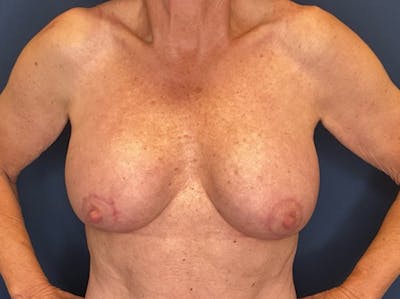  Breast Lift with Augmentation Dr. Booth Before & After Gallery - Patient 788194 - Image 2