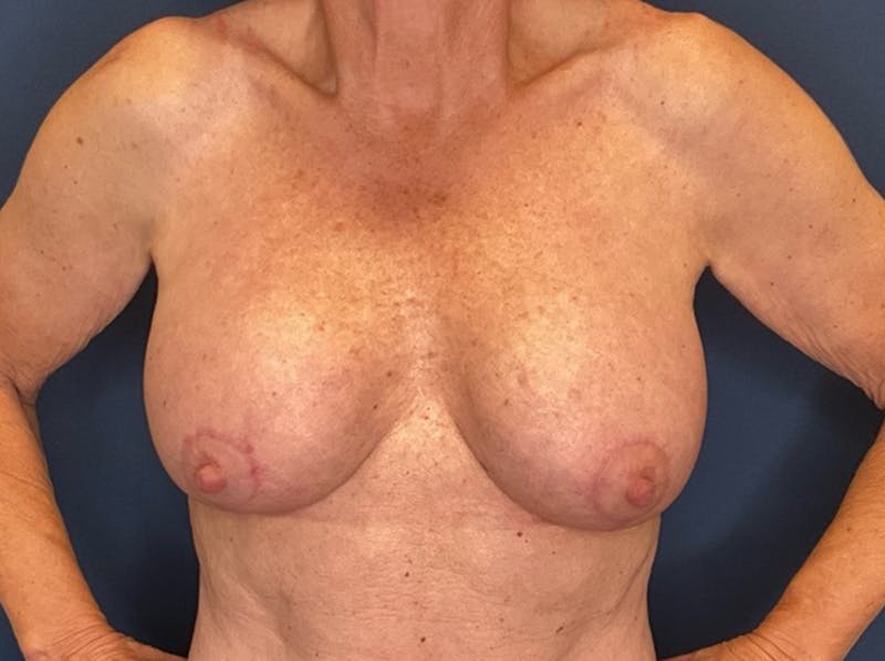  Breast Lift with Augmentation Dr. Booth Before & After Gallery - Patient 788194 - Image 2