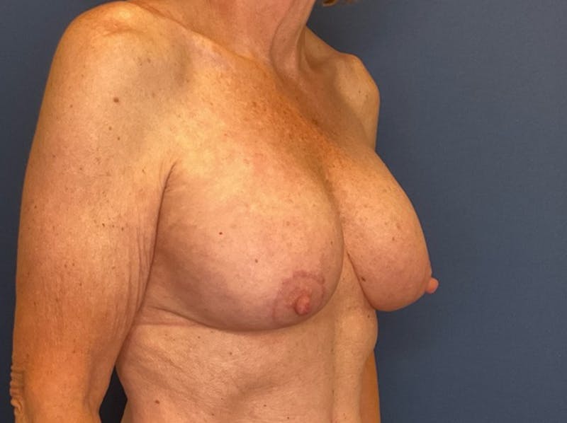  Breast Lift with Augmentation Dr. Booth Before & After Gallery - Patient 788194 - Image 6
