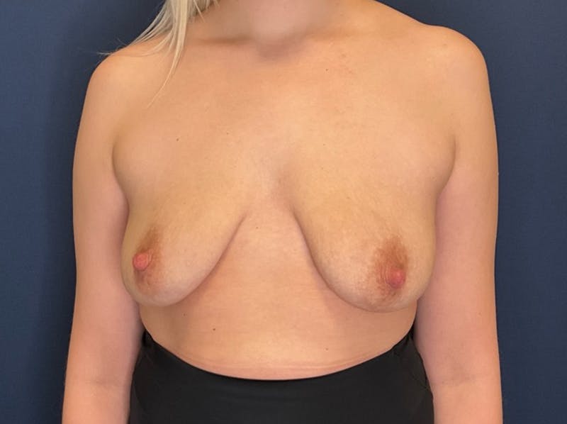  Breast Lift with Augmentation Dr. Booth Before & After Gallery - Patient 194152 - Image 1