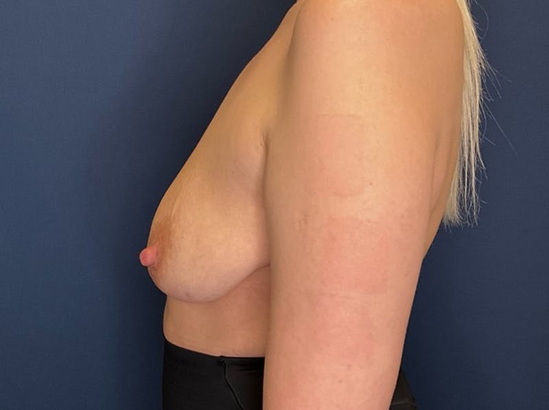  Breast Lift with Augmentation Dr. Booth Before & After Gallery - Patient 194152 - Image 7