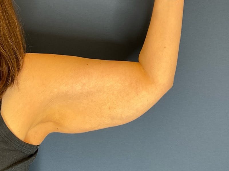 Brachioplasty by Dr. Booth Before & After Gallery - Patient 110401 - Image 3