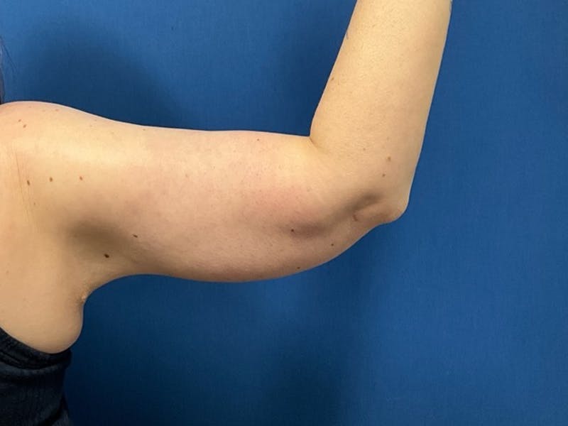 Brachioplasty by Dr. Booth Before & After Gallery - Patient 110401 - Image 4