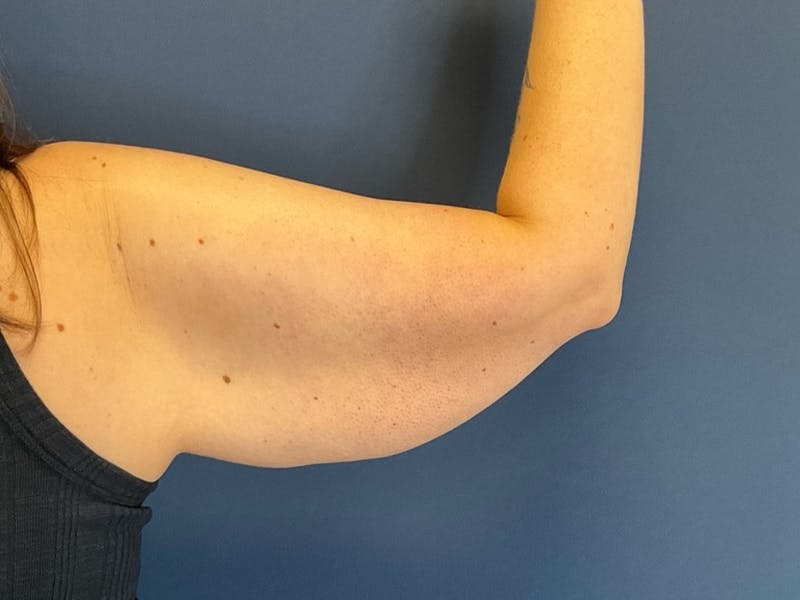 Brachioplasty by Dr. Booth Before & After Gallery - Patient 110401 - Image 1