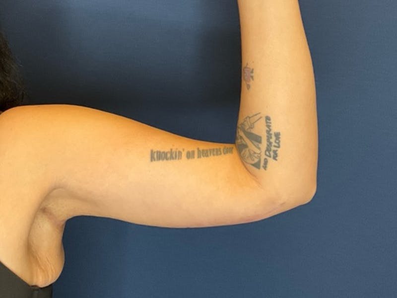 Brachioplasty by Dr. Booth Before & After Gallery - Patient 380840 - Image 4