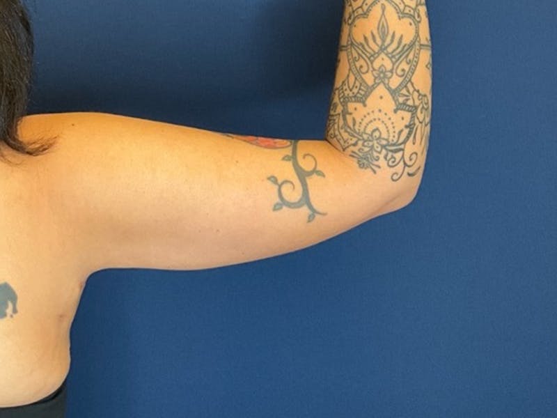 Brachioplasty by Dr. Booth Before & After Gallery - Patient 380840 - Image 2