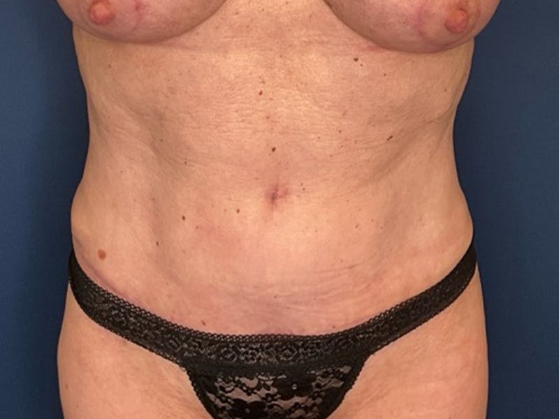 Tummy Tuck by Dr. Booth Before & After Gallery - Patient 422002 - Image 2