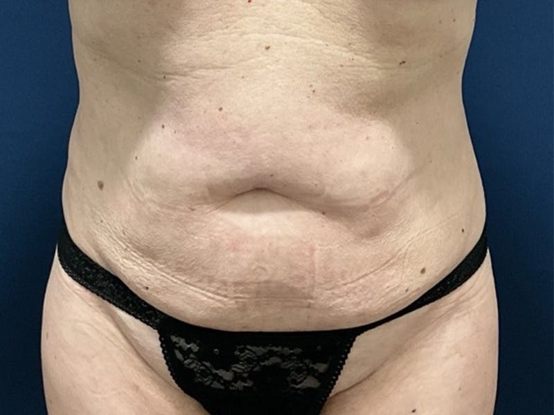 Tummy Tuck by Dr. Booth Before & After Gallery - Patient 422002 - Image 1