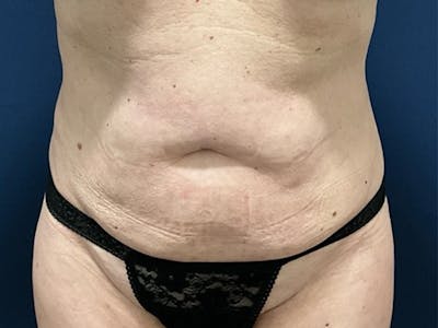 Tummy Tuck by Dr. Booth Before & After Gallery - Patient 422002 - Image 1