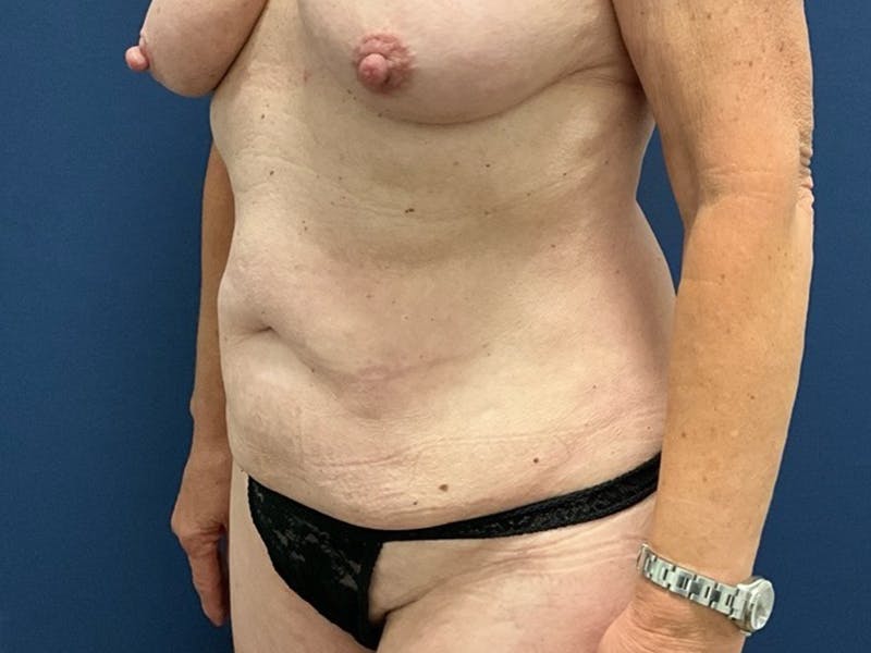 Tummy Tuck by Dr. Booth Before & After Gallery - Patient 422002 - Image 3