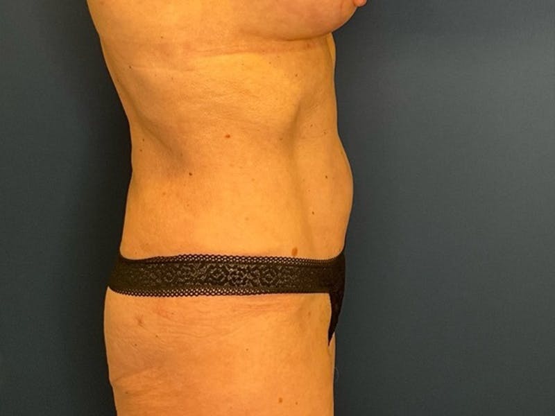 Tummy Tuck by Dr. Booth Before & After Gallery - Patient 422002 - Image 8