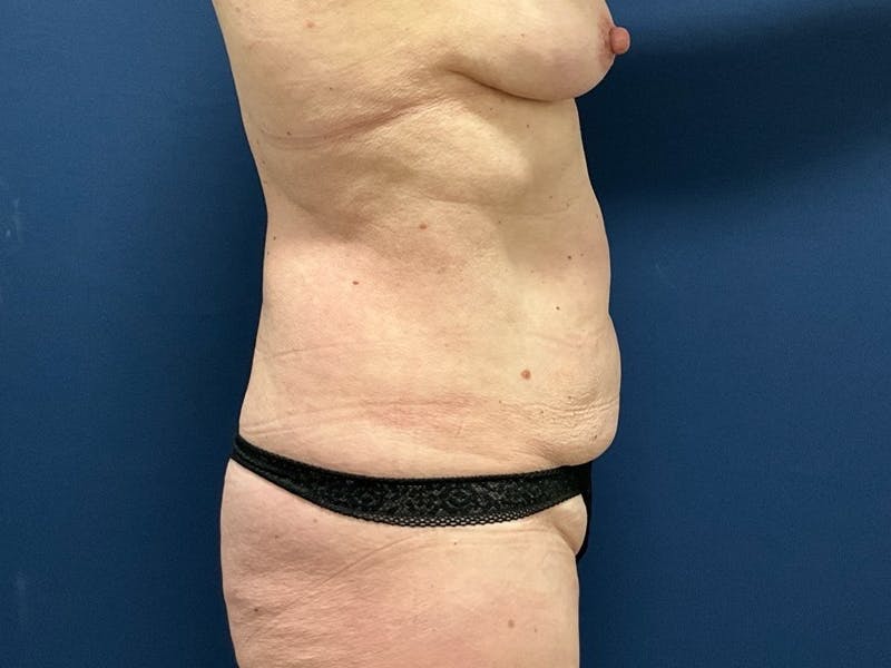 Tummy Tuck by Dr. Booth Before & After Gallery - Patient 422002 - Image 7