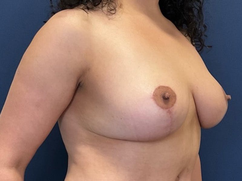 Breast Lift by Dr. Booth Before & After Gallery - Patient 317679 - Image 4