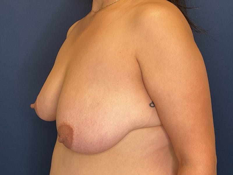 Breast Lift by Dr. Booth Before & After Gallery - Patient 317679 - Image 5