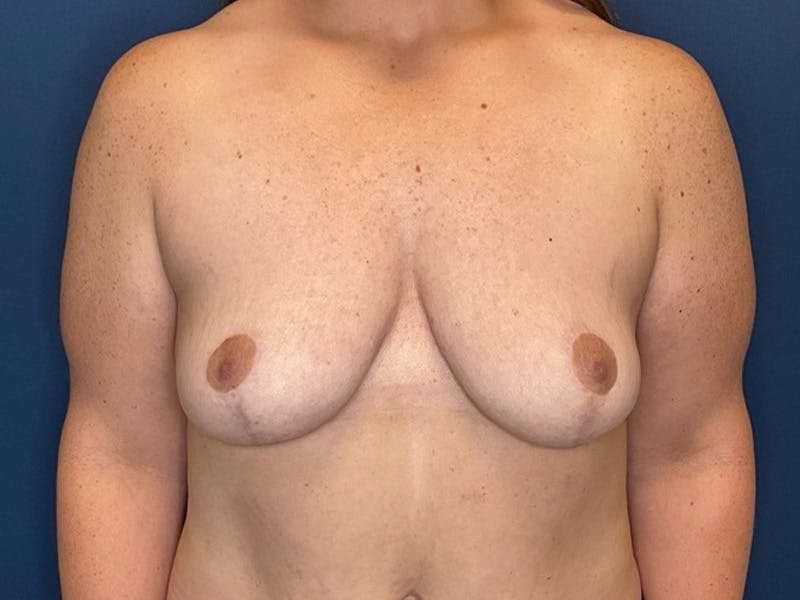 Breast Lift by Dr. Booth Before & After Gallery - Patient 192738 - Image 2