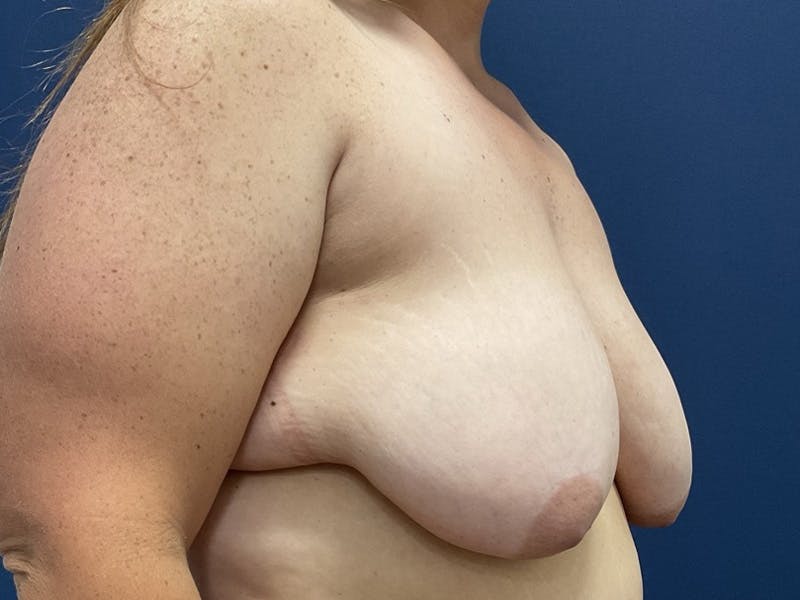 Breast Lift by Dr. Booth Before & After Gallery - Patient 192738 - Image 3